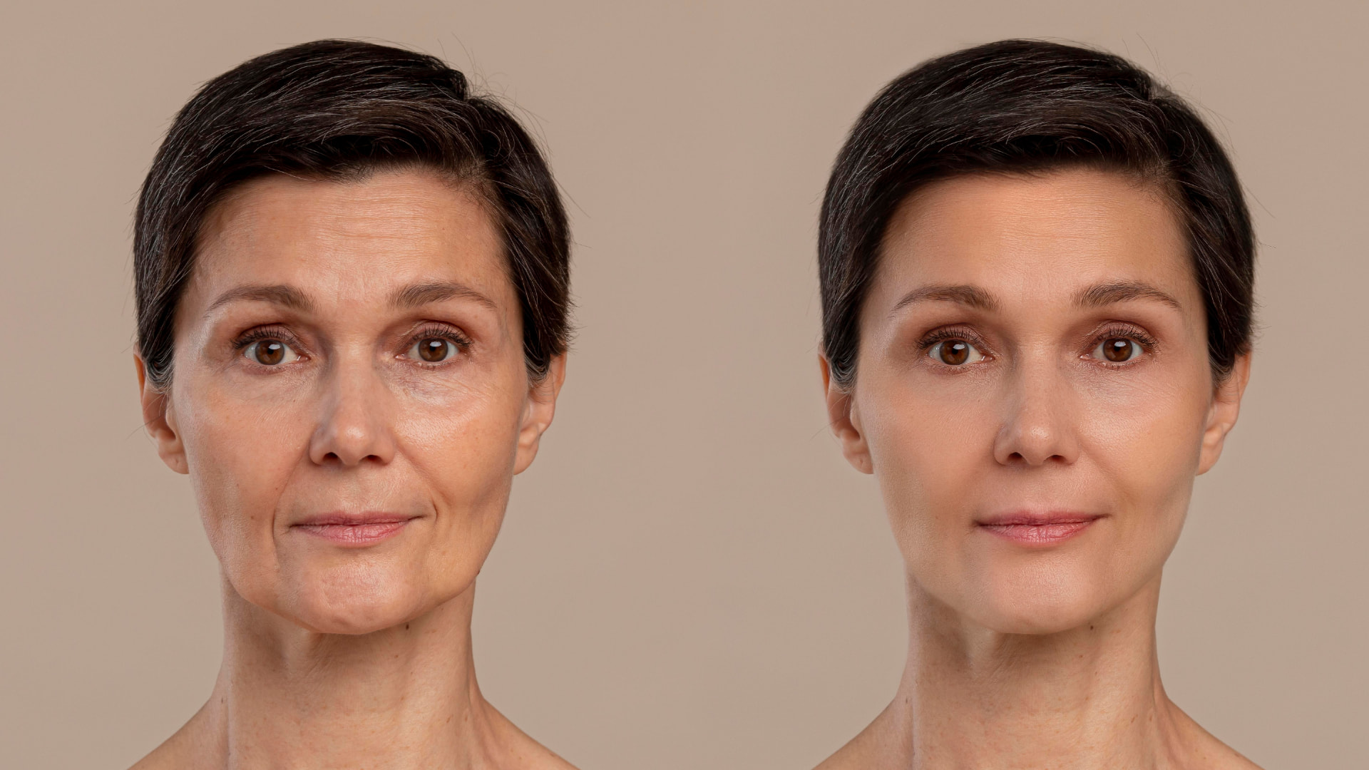Antes e depois: Melasma e acne
